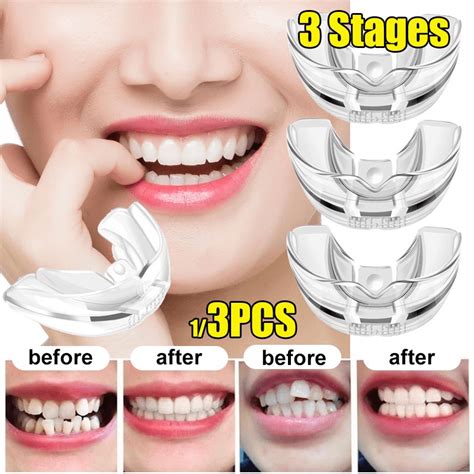 Magic teeth straightener for an immediate smile enhancement